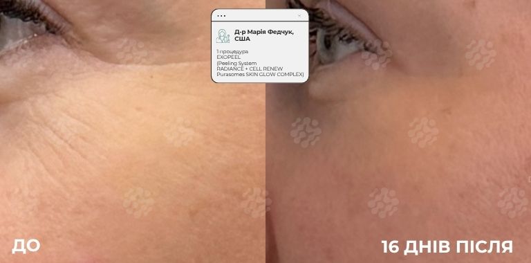 EXOPEEL (4)