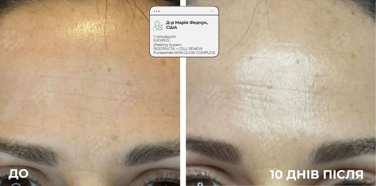 EXOPEEL_1